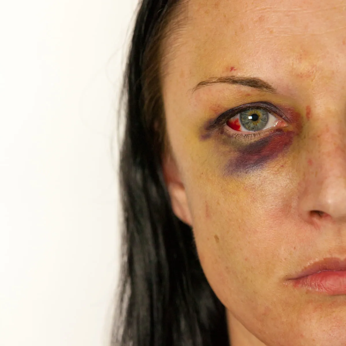 Close-up of Stacey's face against a white background, one eye heavily bruised and bloodshot